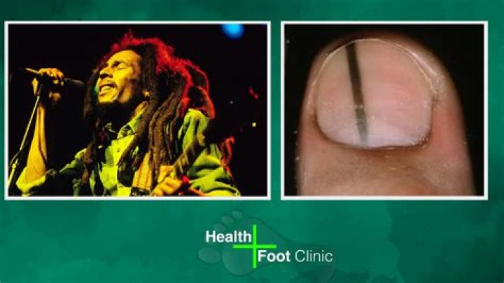 Did Bob Marley Have His Toe Removed? Uncovering the Truth Behind the Reggae Legend's Toe